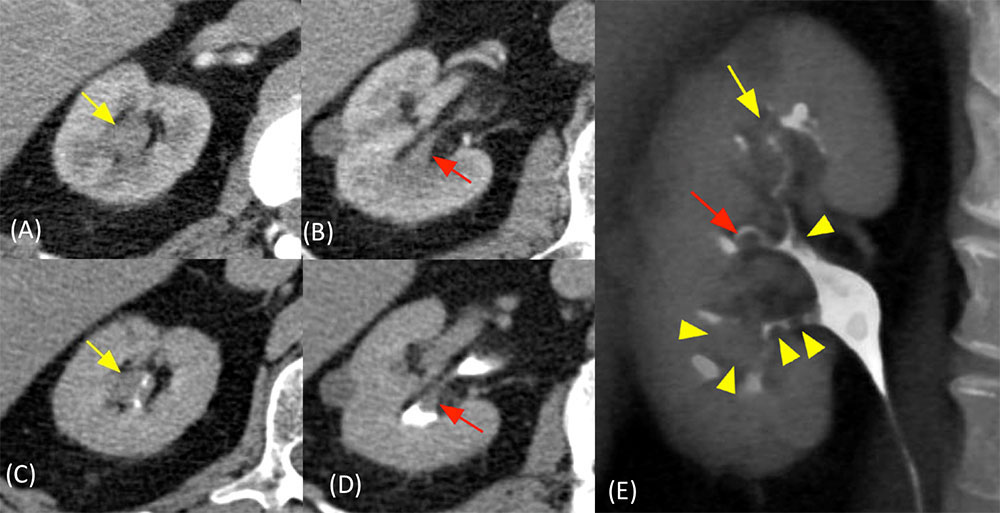 Multifocal Urothelial Carcinomas