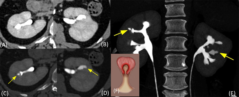 Papillary Necrosis