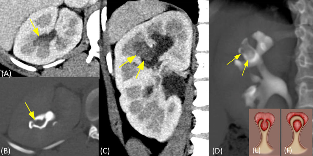 Papillary Necrosis with Sloughed Papilla