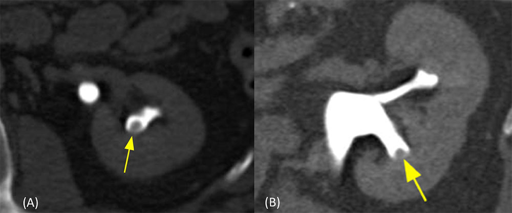 Prominent normal papilla