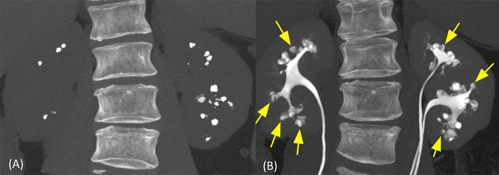 Medullary Sponge Kidney (1)