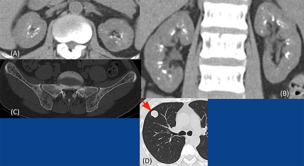 Medullary Nephrocalcinosis