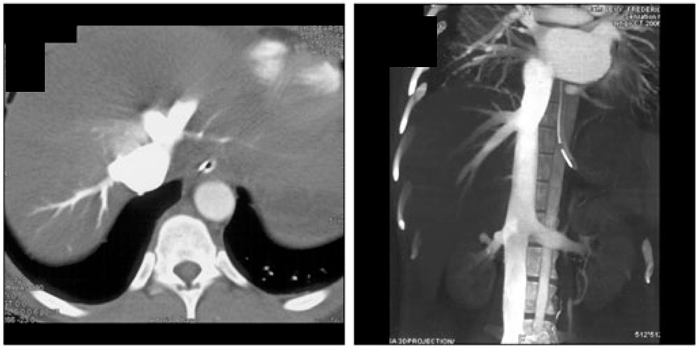 Miscellaneous conditions:Retrograde opacification of the IVC