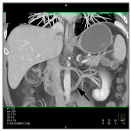 Anatomic variant: Circum aortic left renal vein