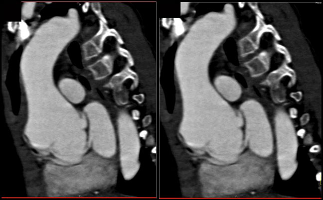 Dilated Aortic Root