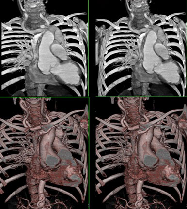 Dilated aortic root as well ectatic carotid arteries