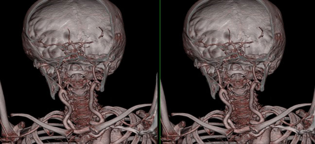 Tortuous Carotid Arteries