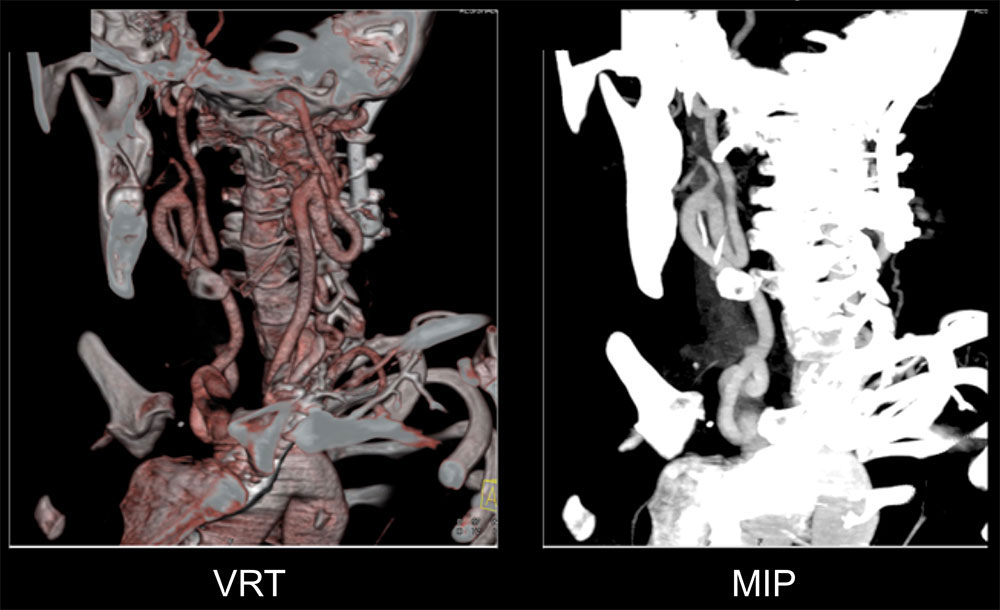 Loeys-Dietz Syndrome: Ectatic Carotid Artery