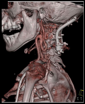 Loeys-Dietz Syndrome: Ectatic Carotid Artery