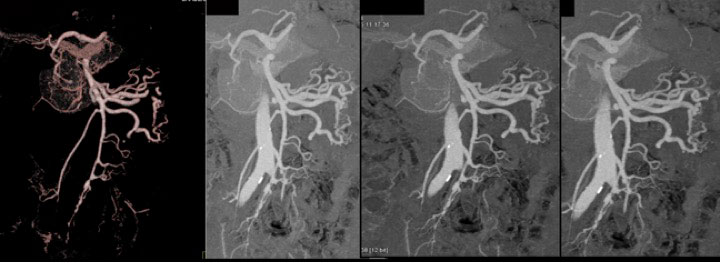 Small Aneurysms of the SMA