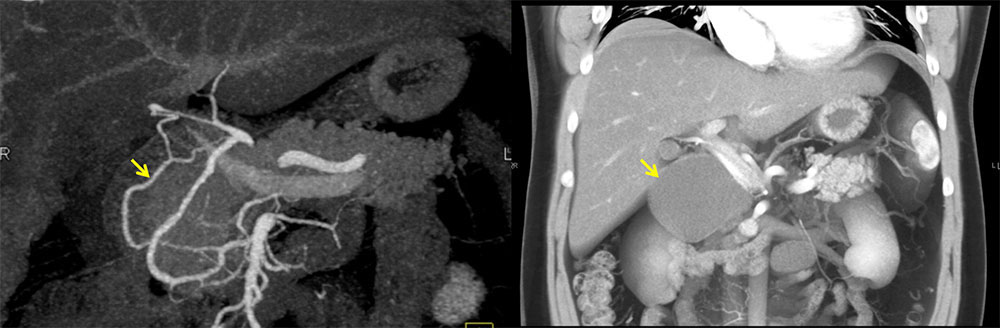 3DCT demonstrates large mass adjacent to pancreatic head.