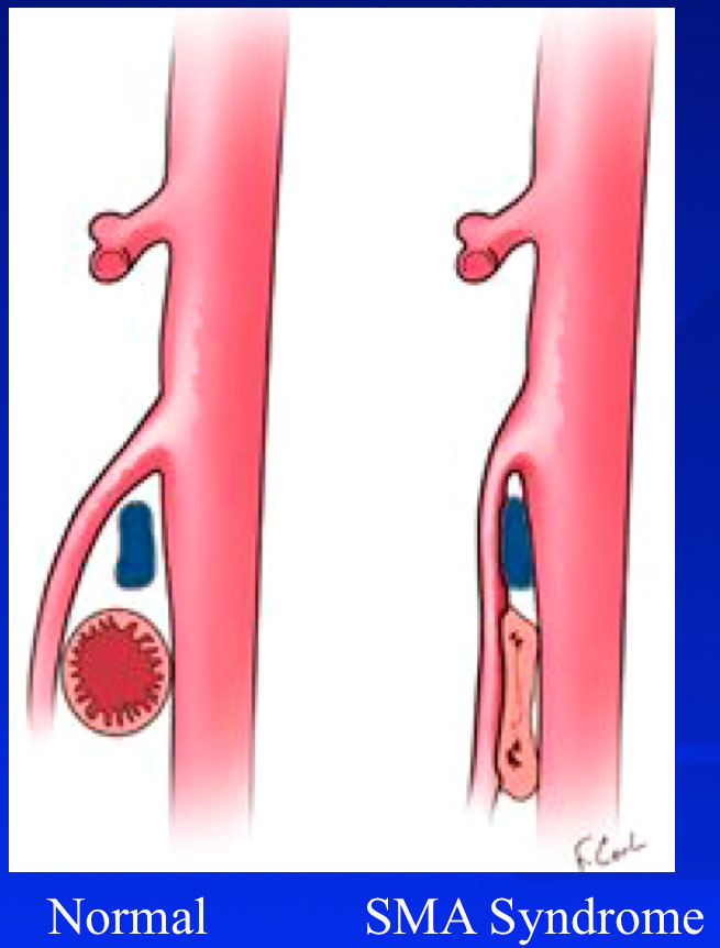 Superior Mesenteric Artery (SMA) Syndrome