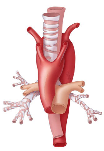 Double Aortic Arch