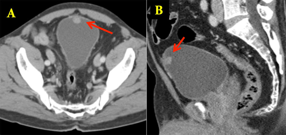 Urachal Carcinoma