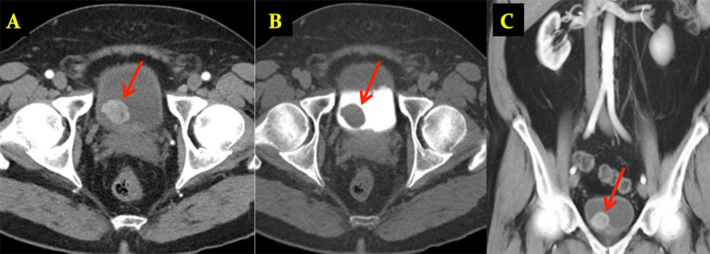 Bladder Paraganglioma