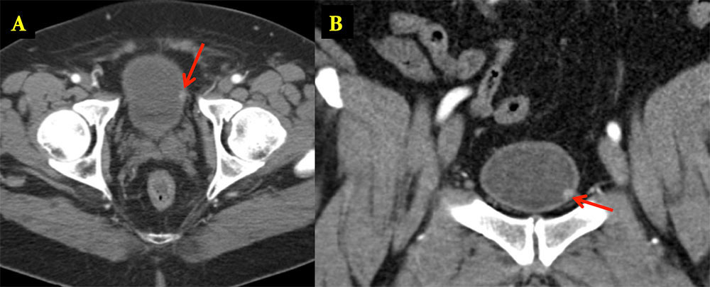 Bladder Paraganglioma