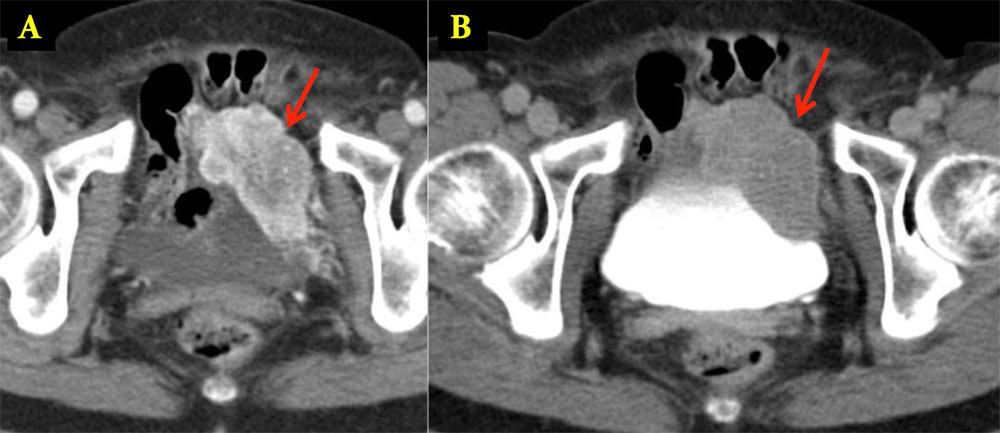 Bladder Paraganglioma