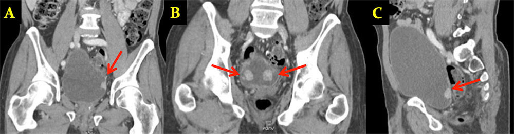 SECONDARY MALIGNANCIES: Metastatic Disease