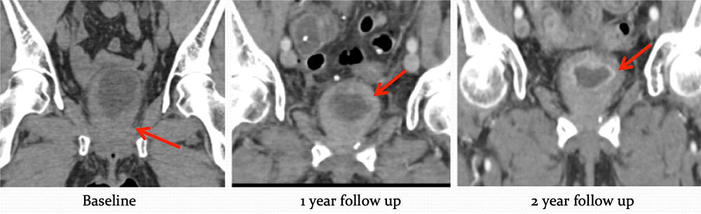 Metastatic Disease