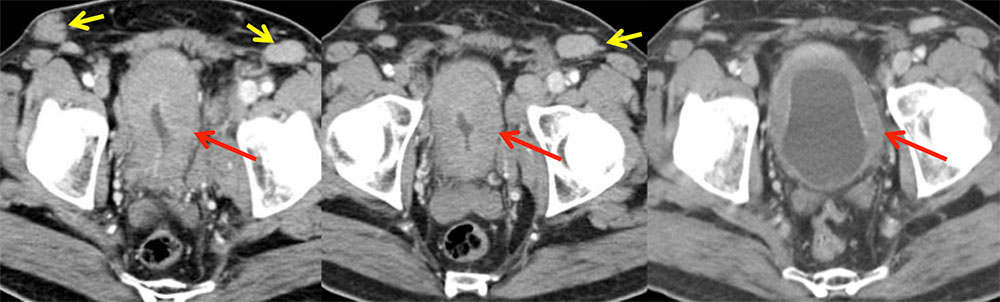 Bladder Lymphoma