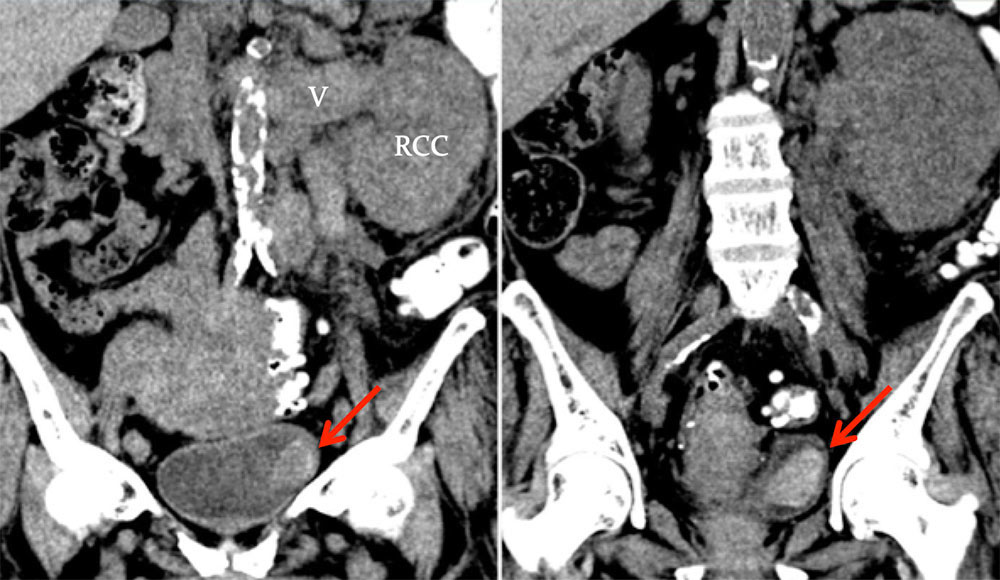 BENIGN MIMICS OF TUMOR: Bladder Hematoma