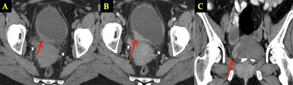 Malakoplakia