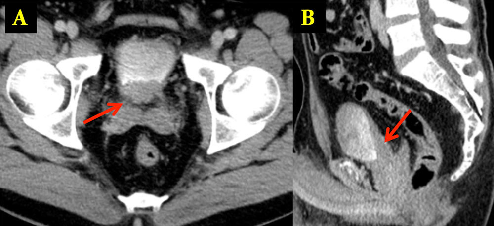 Cystitis Cystica