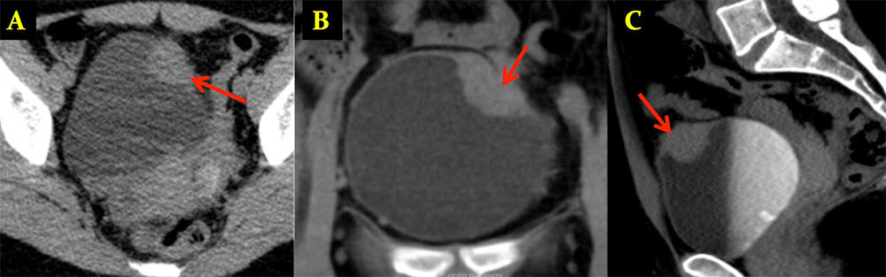 Mullerianosis