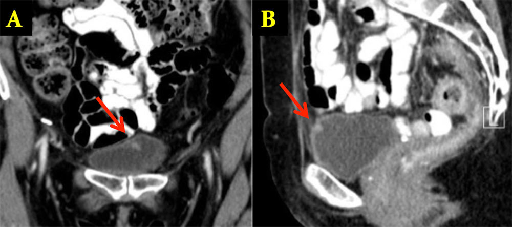 Urachal Cyst