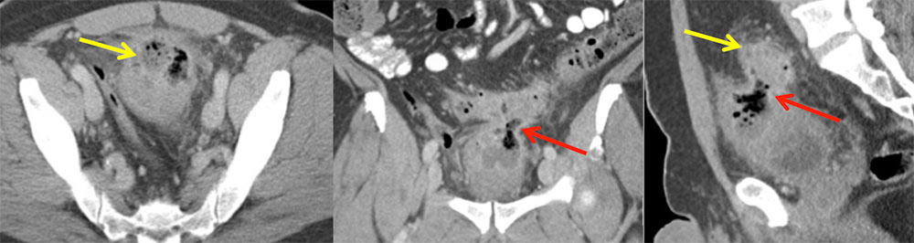 CHANGES IN MORPHOLOGY: Colovesical Fistula