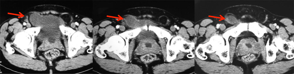 Herniating Bladder