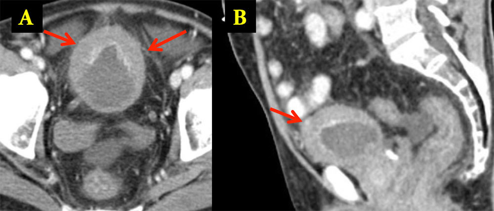 INFECTIOUS PROCESSES: BK Cystitis