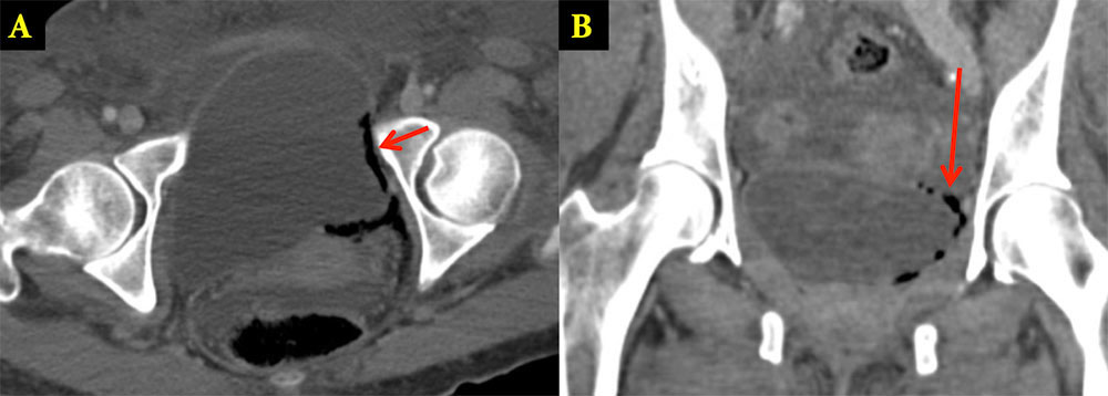 Emphysematous Cystitis