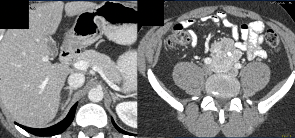 Pheochromocytoma in Organ of Zuckerkandl