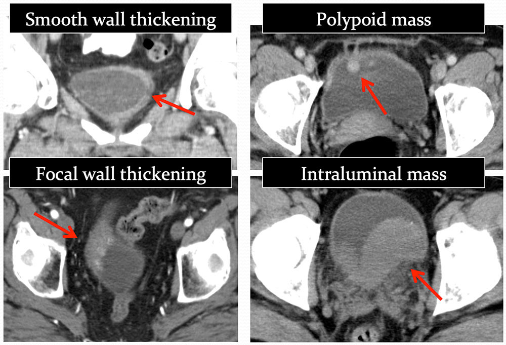 PRIMARY MALIGNANCIES: Transitional Cell Carcinoma