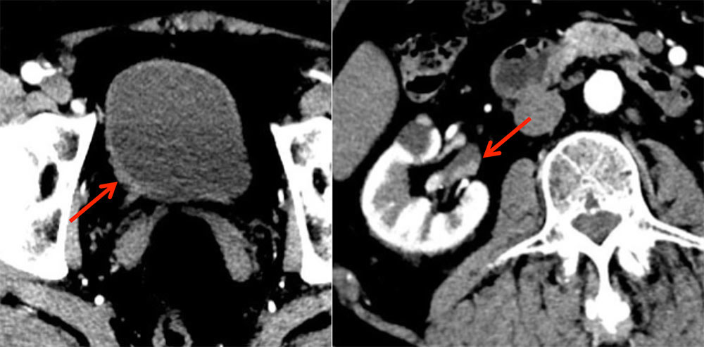 Multifocal TCC