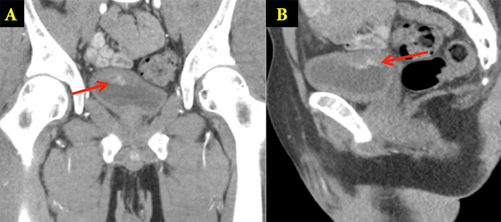 Incidental Bladder Tumor