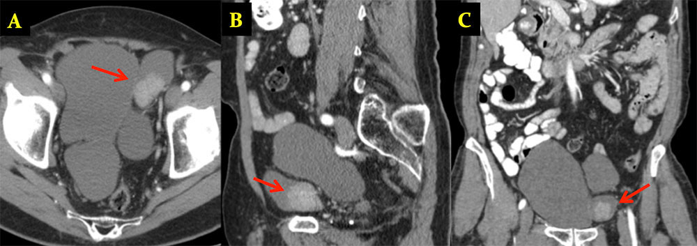 TCC in Bladder Diverticulum