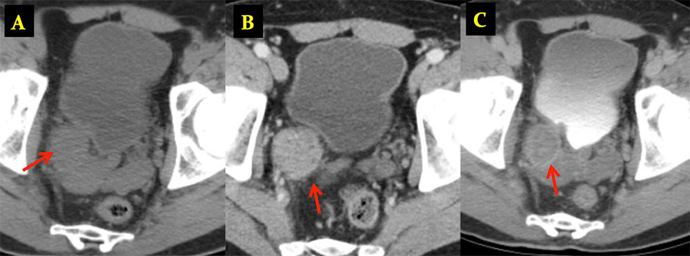 TCC in Bladder Diverticulum