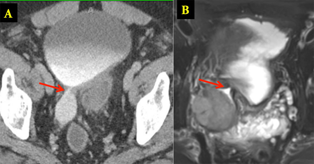 TCC in Bladder Diverticulum