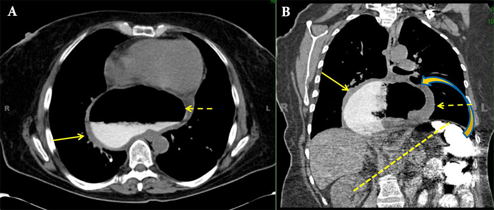 Case 16: Volvulus with Gastric Ischemia