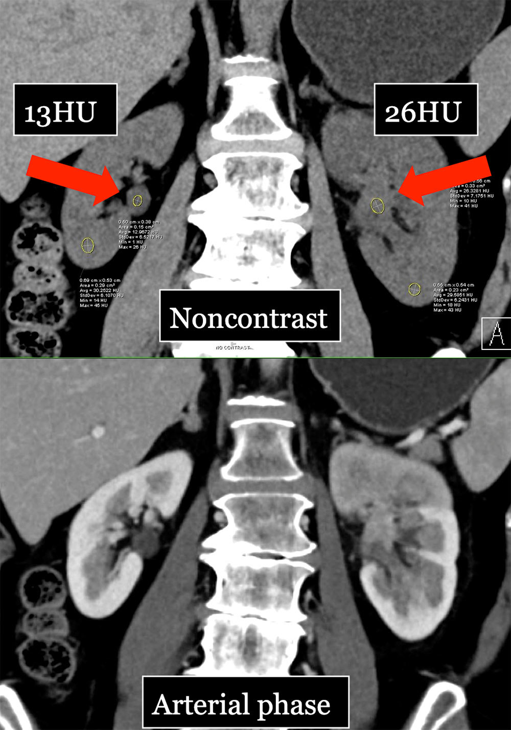 TCC Left Renal Pelvis