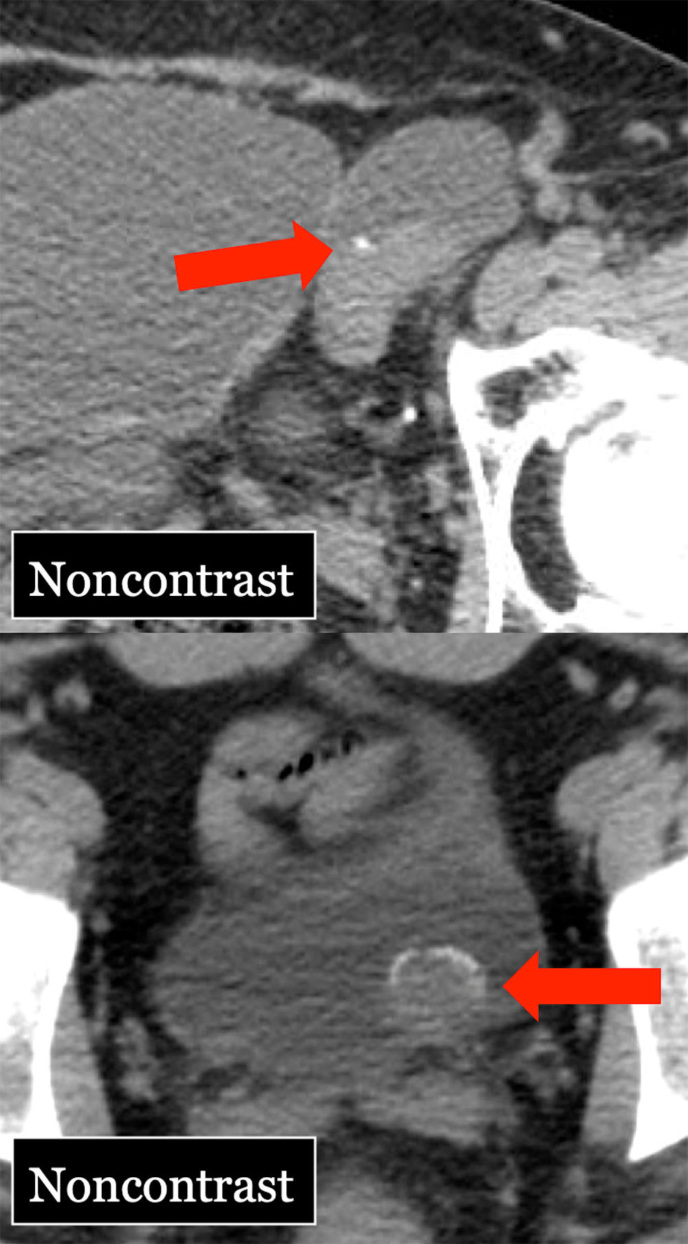 Calcification in TCC