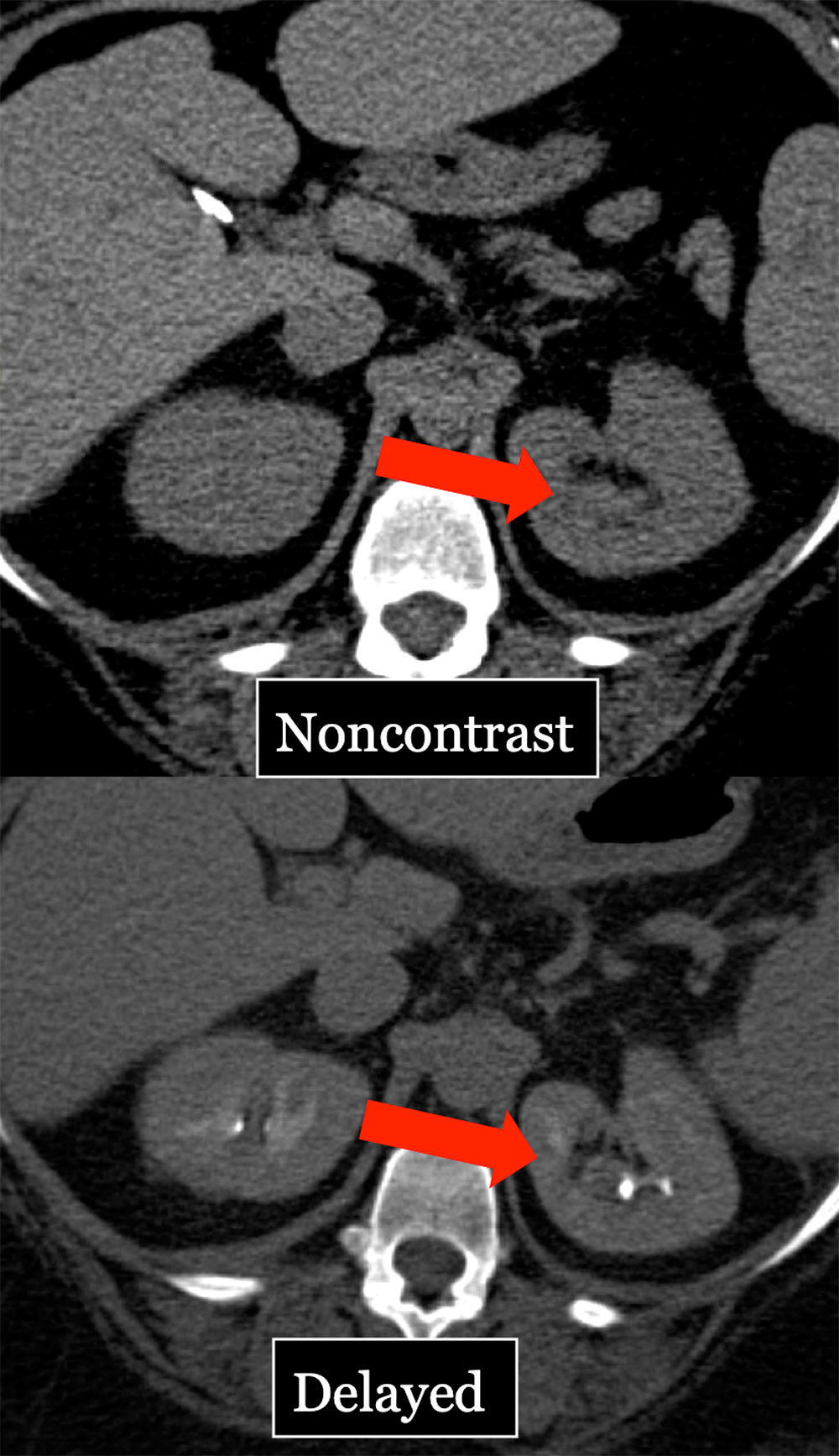 Pitfall: Collecting System Hematoma