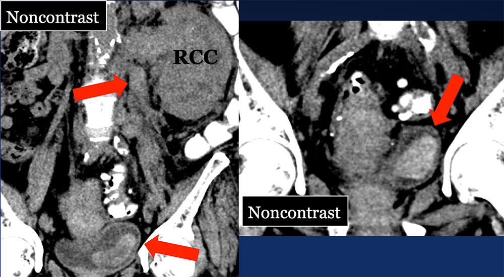 Pitfall: Collecting System Hematoma