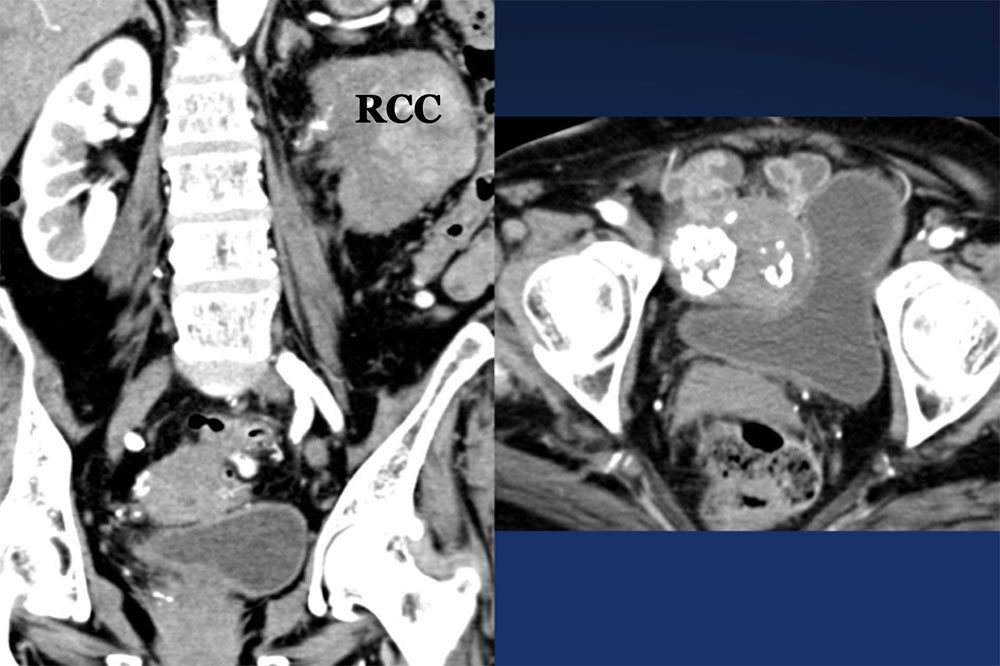 Pitfall: Collecting System Hematoma