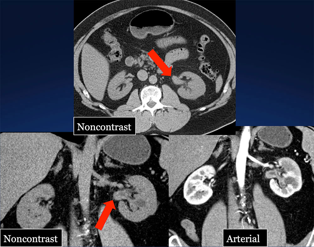 TCC Left Renal Pelvis