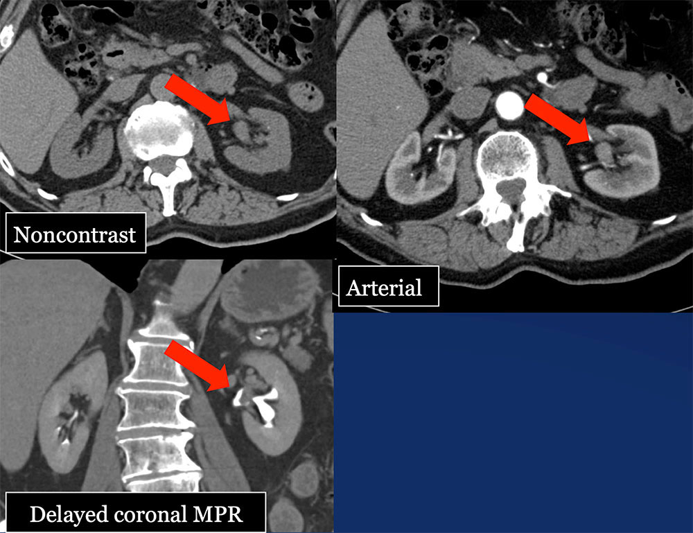 TCC Left Renal Pelvis