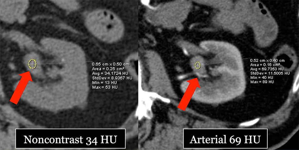 TCC Left Renal Pelvis