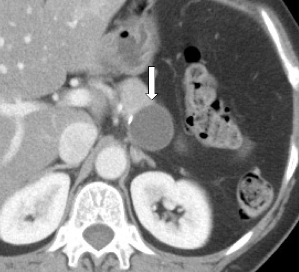 Mucinous Cystic Neoplasm